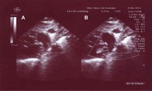 A) Hipertrofia y dilatación del VD en imagen apical. B) Ductus residual (1mm) con mínima señal Doppler en su interior.