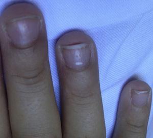 Pitting ungueal en los dedos de ambas manos.