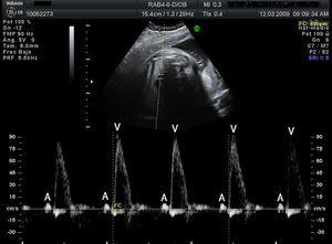 Registro doppler (simultáneo de cava superior y aorta) de bradicardia sinusal en el cual cada contracción ventricular (V: flujo anterógrado en aorta) va precedida de flujo retrógrado en vena cava superior ocasionado por la contracción auricular (A).