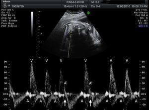Registro doppler (simultáneo de cava superior y aorta) de extrasístoles bloqueadas (A’). Se puede apreciar cómo A’ se adelanta respecto a la contracción auricular del latido sinusal (A) y no es seguida de contracción ventricular (V).