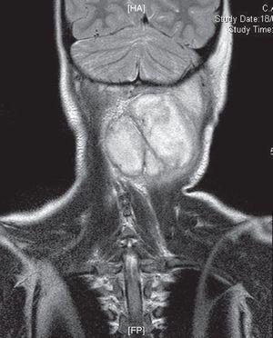 RM de cráneo: masa multiquística de localización cervical posterior izquierda que cruza línea media. Extensión craneocaudal 6,6cm×7,5cm×3,9cm.
