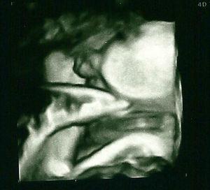 Imagen de la ecografía prenatal en la semana 32 del caso 2. El miembro inferior izquierdo está en hiperextensión, quedando el pie en la boca.
