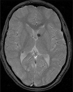 Imagen de resonancia magnética, axial T2*, exhibiendo focos de hiposeñal subependimarios, con proyección hacia el interior de los ventrículos, indicativos de nódulos subependimarios calcificados.