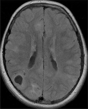 Imagen de resonancia magnética, axial FLAIR, que revela tuberoma cortical quístico parietal derecho.