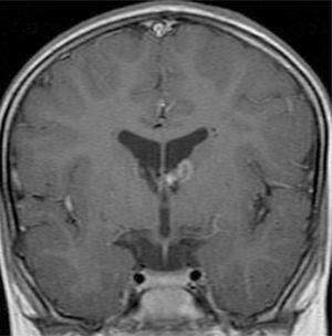 Imagen de resonancia magnética, coronal T1 posgadolinio, que muestra astrocitoma de células gigantes adyacentes al agujero de Monro a la izquierda.