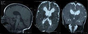 RM cerebral mostrando hipoplasia del cuerpo calloso, aumento del tamaño ventricular mayor en astas frontales, áreas de paquigiria fronto-basal y polimicrogiria bitemporal.