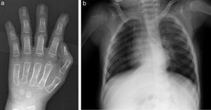 a) Hipoplasia de falanges distales. Edad ósea de 18 meses a los 3 años de edad cronológica. b) Ensanchamiento de región lateral de arcos costales y de región medial de ambas clavículas.