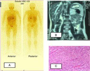 Paciente 2. A) Gammagrafía MIBG I123: hiperfijación a nivel de suprarrenal izquierda. B) RM abdominal: tumoración redondeada en localización anterior y superior al riñón izquierdo, intensidad heterogénea con hiperintensidad en T2. C) Tumoración constituida por nidos de células poligonales rodeados por finos capilares. Las células muestran citoplasma amplio eosinófilo y granular. El núcleo es grande con cromatina abierta y nucléolo patente.