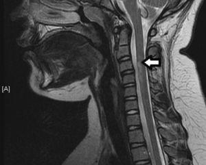 Aumento de calibre medular en el segmento entre los cuerpos vertebrales de C3-C4, con lesión fusiforme hiperintensa (T2) que afecta la porción anterior y periférica de la médula.