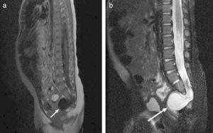 Síndrome de Currarino. a) RM sagital T1. b) T2 que muestran agenesia parcial del segmento derecho del sacro desde S3, con meningocele presacro por debajo de S2 (flecha blanca).
