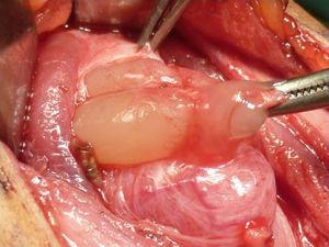 Exéresis de lesión cística de contenido mucinoso en espesor de la glándula tiroides.