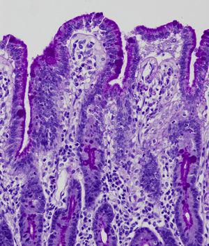 Tinción de PAS. Acúmulo de material PAS positivo en el citoplasma apical de los enterocitos.