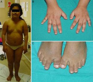 A) Características clínicas de la paciente. B) Detalle de las manos. C) Detalle de los pies.