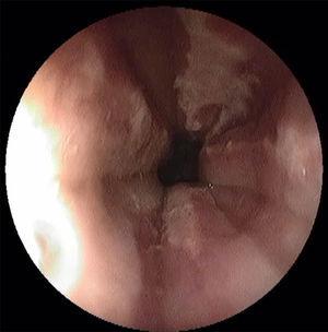 Imagen de endoscopia digestiva alta que muestra en el tercio medio e inferior del esófago una mucosa intensamente inflamada con erosiones y úlceras longitudinales.