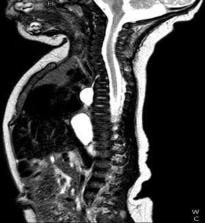 RM posnatal: extensa lesión quística bilobulada del mediastino posterior con trayecto fistuloso hasta el cuerpo vertebral de D3. Se objetiva pinzamiento D3-D4 y pequeña escotadura central en el platillo inferior de D3 y superior de D4, sin comunicación con el canal raquídeo ni alteraciones medulares, compatible con quiste neuroentérico.