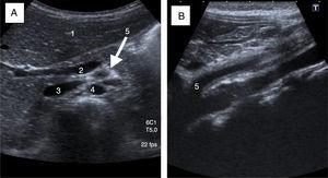 Arteritis de la arteria mesentérica superior valorada mediante ecografía (caso 2). A) Corte sagital: halo hiperecogénico alrededor de la arteria mesentérica superior (AMS) por engrosamiento de la pared de la misma. 1: parénquima hepático; 2: eje espleno-portal; 3: vena cava inferior; 4: arteria aorta; 5: AMS. B) Corte coronal: engrosamiento de la AMS de 2mm de grosor desde su inicio en aorta hasta la bifurcación (4,3cm).