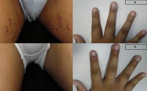Paciente de 13 años, con verrugas víricas en región inguinal bilateral y dedos de las manos (a), resueltas tras 2 meses de tratamiento (b).