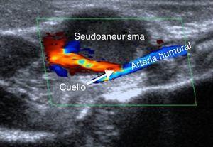 Relación entre el seudoaneurisma y la arteria humeral a través de un fino cuello.