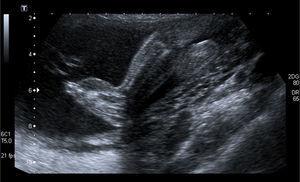 Ecografía prenatal de 20 semanas, donde se observa importante edema de pies.