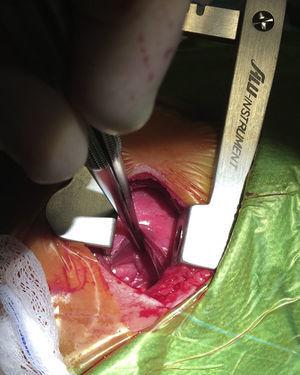 Abordaje extrapleural en la cirugía del ductus arterioso persistente. Nótese como el pulmón izquierdo está retraído con la pinza. La pleura visceral se encuentra íntegra y ha sido separada mediante disección roma de la pared torácica. La aorta descendente se puede observar en el fondo de la imagen.
