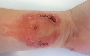 Dermatitis de contacto por PPDA con lesiones necróticas tras tatuaje de un fénix con henna negra adulterada con PPDA. Las lesiones dejarán cicatrices permanentes.