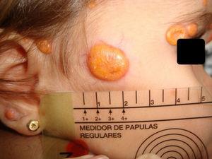Múltiples lesiones macronodulares de coloración amarillenta a nivel facial.