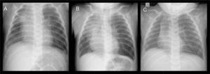 Radiografías de tórax a los 4 (A), a los 5 (B) y a los 8 meses de vida (C). Nótese la marcada disminución del tamaño pulmonar derecho y la desviación mediastínica hacia ese mismo lado, así como la hiperinsuflación pulmonar izquierda con herniación del lóbulo superior.