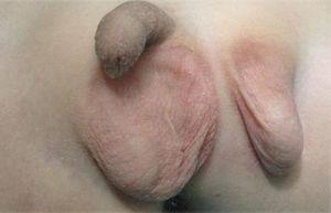 Ectopia testicular izquierda. Presencia de hemiescroto izquierdo ectópico, conteniendo teste normal y separado del resto de la bolsa escrotal y del teste derecho por piel perineal.