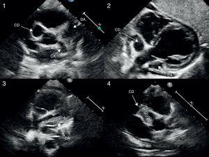 Imagen ecocardiográfica (plano paraesternal corto alto modificado a nivel de grandes arterias para valoración de raíz aórtica y arterias coronarias) en el que se objetiva la presencia de aneurismas gigantes en los segmentos proximales de las tres arterias coronarias principales (imágenes 1 y 2). Ecocardiografía de control en la que se evidencian trombos intraluminal en ADA y CD, manteniéndose la función cardiaca sistólica conservada (imágenes 3 y 4).