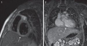 Imagen de RM cardiaca de perfusión con dipiridamol. Se identifica la zona de hipoperfusión en la pared inferior, necrosis y ausencia de viabilidad en un segmento de la misma (imagen 1), así como hipoperfusión sin signos de daño miocárdico en territorio de ADA (imagen 2).
