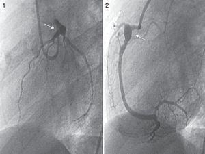 Imágenes de coronariografías. Proyección OAI a 60° del árbol coronario izquierdo (imagen 1), donde se visualiza un aneurisma gigante de TCI distal y ostium de ADA. Proyección OAI a 60° de ACD (imagen 2) con presencia de aneurisma gigante en segmento proximal.