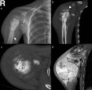 a) Radiografía simple del hombro derecho, que muestra una lesión mixta osteolítica y hueso esclerótico en la porción proximal del húmero, con destrucción irregular de la cortical y reacción perióstica agresiva (flecha fina); se observa un ganglio calcificado de 13mm en su diámetro máximo (flecha gruesa); b) Corte coronal de la TAC que muestra nódulo epifisario óseo calcificado (triángulo); c) Corte axial de la lesión que muestra extensa matriz ósea tumoral (asterisco); d) Corte coronal en secuencia STIR de la RMN, que muestra un gran componente de partes blandas (flecha negra).