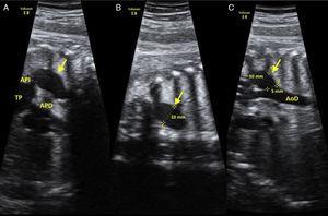 Ecocardiografía prenatal. Imagen 2D. Planos modificados. La flecha representa el aneurisma ductal. A) Tronco pulmonar y su conexión con el ductus aneurismático. B) Medida transversal de ADA (10 mm). C) Conexión del ductus aneurismático con la aorta torácica (5 mm). AoT: aorta torácica; APD: arteria pulmonar derecha; API: arteria pulmonar izquierda; TP: tronco pulmonar.