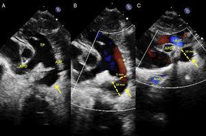 Ecocardiografía al nacimiento. La flecha representa el ADA. A) Imagen 2D eje paraesternal corto. Se observa inserción del ductus aneurismático (10 mm) en la arteria pulmonar izquierda (línea discontinua), con tronco pulmonar ligeramente dilatado. B) Doppler color. Flujo ductal (5 mm) a nivel de la conexión con RPI (línea discontinua). C) Doppler color. Plano supraesternal. AoT y AoD, y relación con el ADA. AoD: aorta descendente; AoT: aorta transversa; APD: arteria pulmonar derecha; API: arteria pulmonar izquierda; TP: tronco pulmonar.