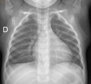 Radiografía de tórax con atelectasia resuelta.