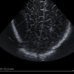 Ecografía transfontanelar preoperatoria del caso 3. Imagen biconvexa hipoecoica parietal posterior derecha de 48×22,5mm, sugestivo de hematoma epidural.