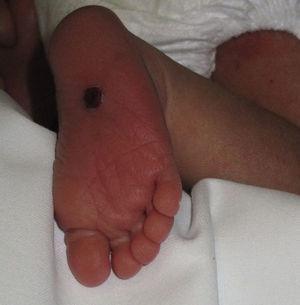 Pápula eritemato-marronácea recubierta por costra hemática y collarete descamativo periférico en planta del pie derecho.