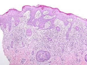 Hematoxilina-eosina de biopsia cutánea, donde se observa una ocupación de la dermis papilar y reticular por histiocitos.
