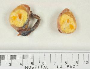 Imagen macroscópica de un teratoma de tipo prepuberal en el testículo de un niño de 6 años. Destaca el aspecto quístico con contenido amarillento y aspecto uniforme.
