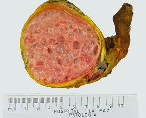 Imagen macroscópica de un teratoma de tipo pospuberal en un paciente de 16 años. Casi la totalidad del parénquima está sustituido por numerosos quistes.