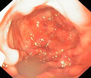 Mucosa de antro gástrico congestiva y edematosa con estenosis pilórica.