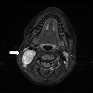 RM cervical: imagen STIR que muestra lesión hiperintensa, con pequeño punteado de más baja señal en su interior, que es independiente de la arteria carótida y la vena yugular interna.