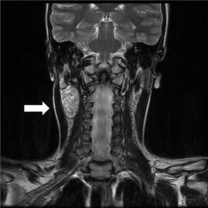 RM cervical: plano coronal con lesión de morfología ahusada, con un eje mayor en el sentido longitudinal, siguiendo el trayecto del nervio vago.