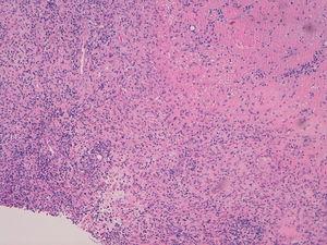 Biopsia incisional de tumoración subcutánea en la muñeca derecha: granuloma necrosante.