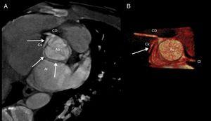 A) Corte axial de la tomografía computarizada multicorte. Las fechas blancas señalan el origen y recorrido de la circunfleja (Cx). Esta se origina en el seno coronario derecho, a partir de un ostium independiente al de la coronaria derecha (CD), con un trayecto retroaórtico entre aorta (Ao) y aurícula izquierda (AI). B) Reconstrucción volumérica 3D.