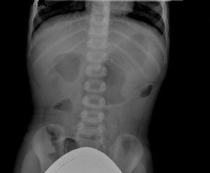 Radiografía de abdomen en bipedestación: «signo de la doble burbuja». Se observa aire distendiendo la cámara gástrica y el duodeno proximal.