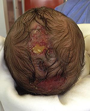 Neonato con múltiples lesiones de aplasia cutis congénita en el cuero cabelludo.