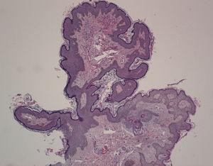 Hiperplasia epidérmica con papilomatosis, hiperqueratosis y pigmentación de la capa basal.