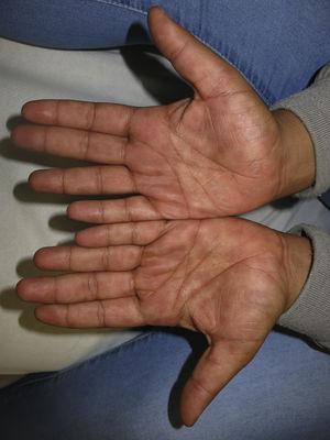 Máculas eritematosas redondeadas en las palmas de las manos.