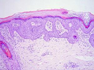Biopsia cutánea que mostró hiperqueratosis, acantosis y capa basal epidérmica con células en empalizada, alteración característica del nevus tipo PENS.